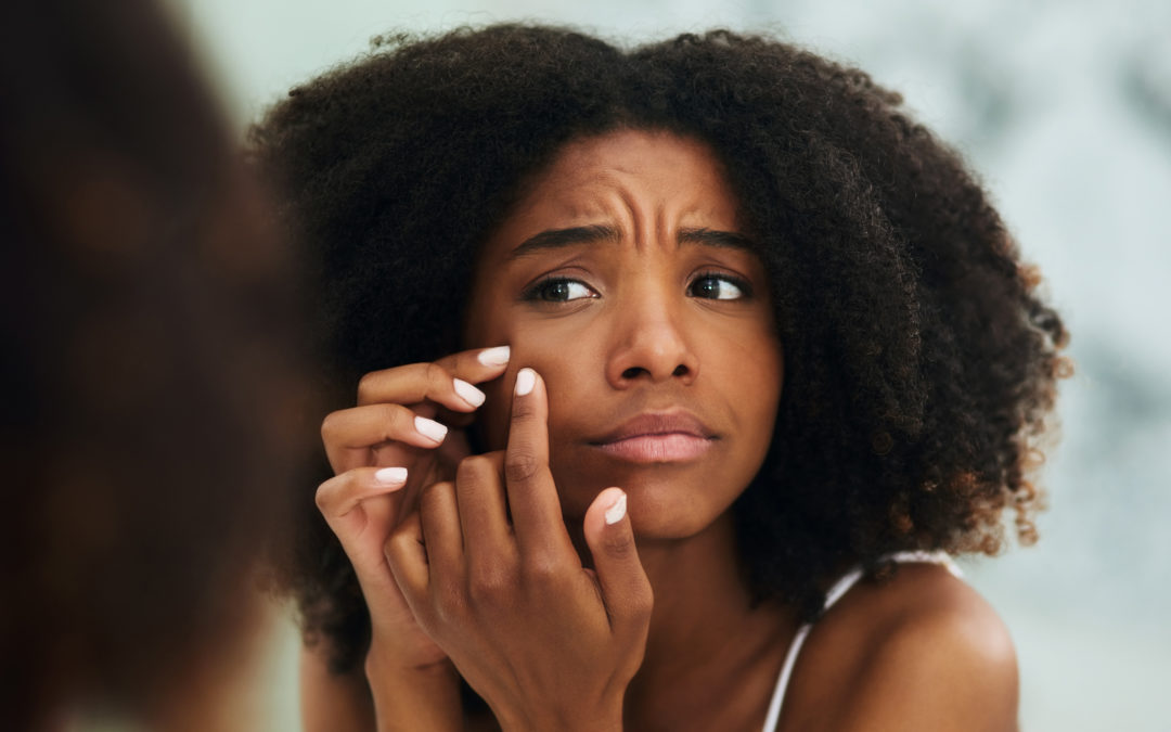 5 Incredible Home Remedies For Acne